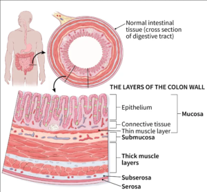 Colon cancer